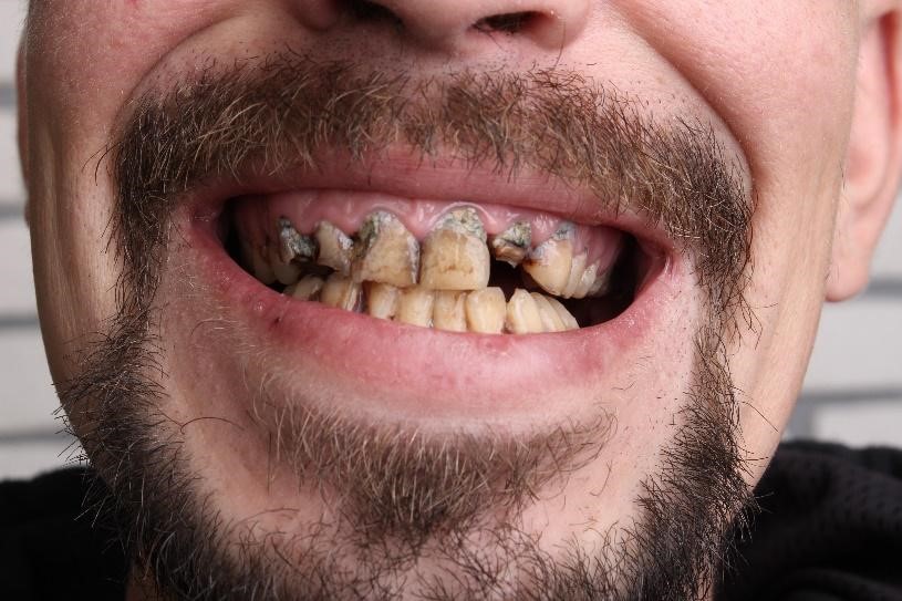 Meth Teeth Effect